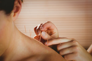 individual participating in acupuncture therapy